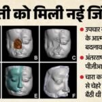 नई जिंदगी:हाइब्रिड डिजिटल तकनीक से युवती को मिला नया चेहरा, पीजीआई के डाॅक्टरों और पीयू के इंजीनियरों का कमाल – Pgi Doctors And Pu Engineers Rebuild Young Woman Face Using Hybrid Technology Details In Hindi
