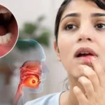 मुंह का छाला 2 हफ्ते में भी नहीं भरा? जानिए ये कैंसर का शुरुआती संकेत तो नहीं